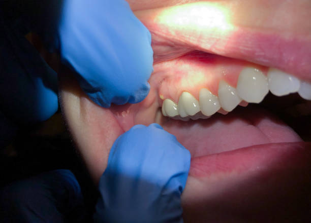 Best Emergency Tooth Extraction in Willimantic, CT